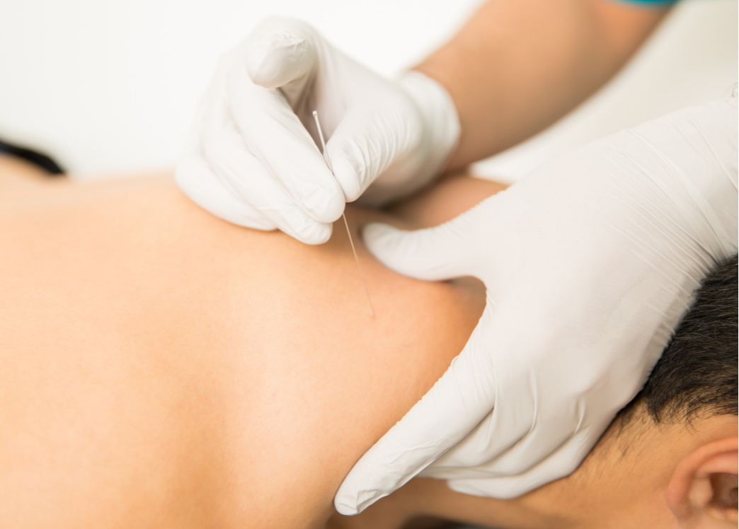 Trigger point dry needling treatment